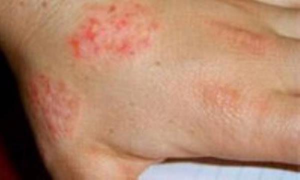 واکنش پوستی آلرژیک به عفونت پوست